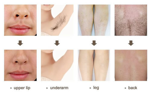 hair removal handle